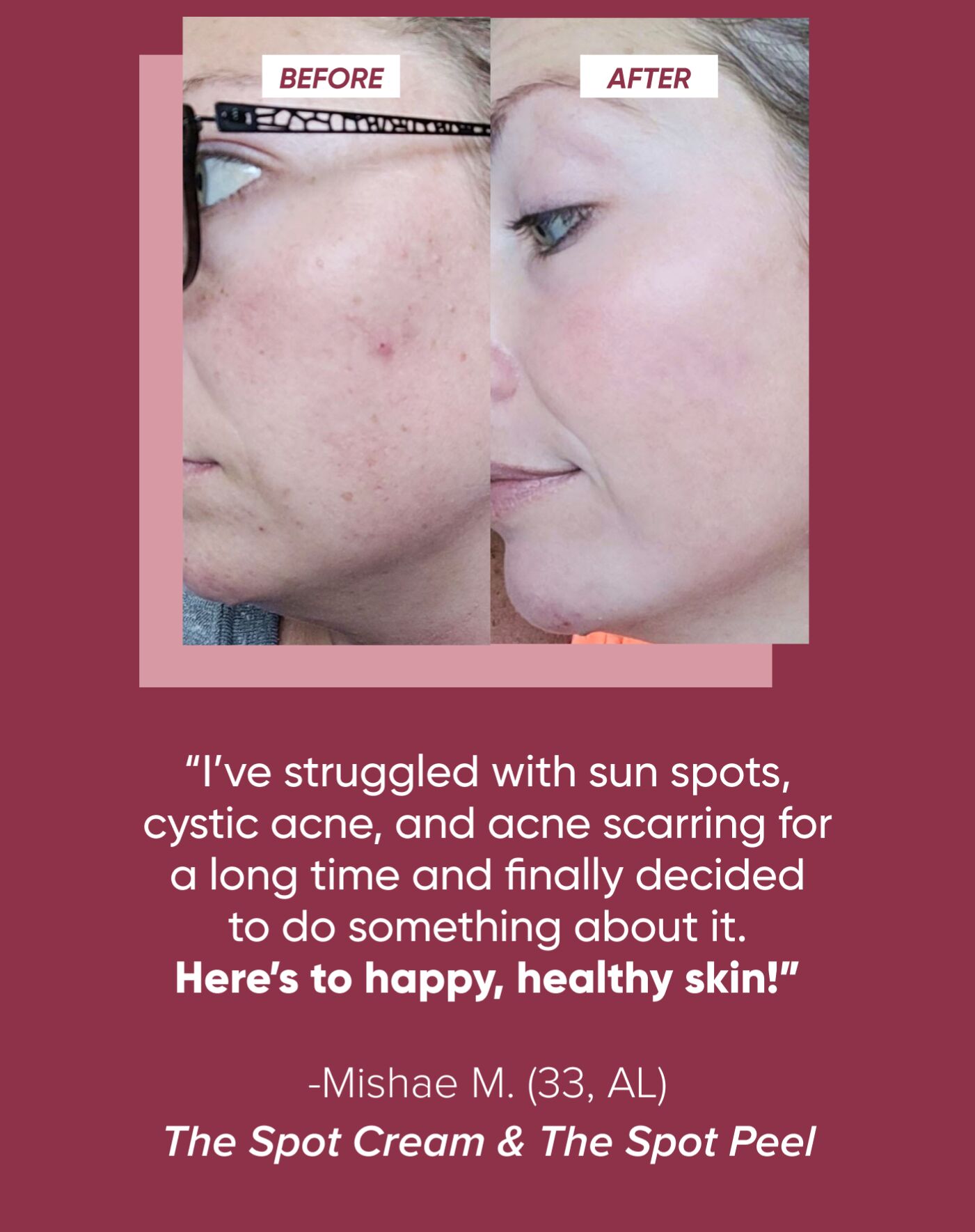 Kickstart Results with The Spot Peel! - Musely